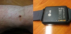 Некоторые LG G Watch травмируют своих владельцев