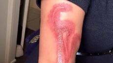 Женщина получила ожог второй степени в результате возгорания iPhone 7