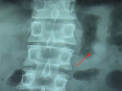 Американка проглотила наушник Apple и позвонила с него своему парню