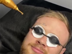 Харьковский блогер убрал со лба татуировку «Кернес жив»