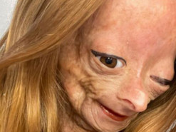 У 15 років померла зірка соцмереж та YouTube, яку рідкісна хвороба перетворила на стареньку