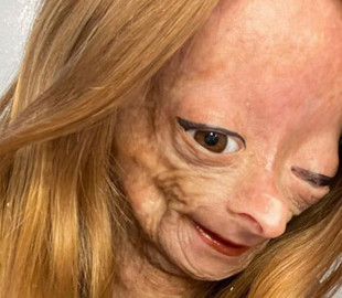 У 15 років померла зірка соцмереж та YouTube, яку рідкісна хвороба перетворила на стареньку