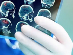 Вчені з'ясували, людям із якою групою крові може загрожувати ранній інсульт