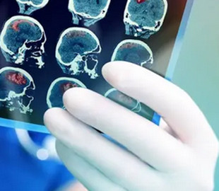 Вчені з'ясували, людям із якою групою крові може загрожувати ранній інсульт