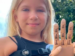 9-річній Саші, яка втратила руку під час обстрілів Бучі, встановили протез