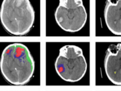 Искусственный интеллект автоматически определяет типы травм мозга