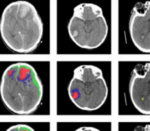 Искусственный интеллект автоматически определяет типы травм мозга