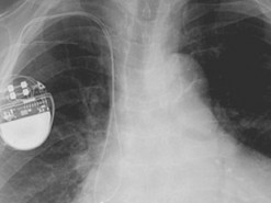 Хакеры нашли способ остановить сердце