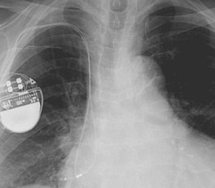 Хакеры нашли способ остановить сердце