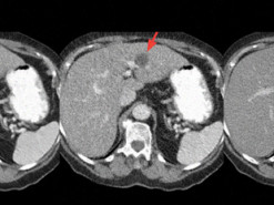 Нейросеть поможет снизить дозу излучения при компьютерной томографии
