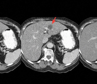 Нейросеть поможет снизить дозу излучения при компьютерной томографии