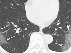 Компьютер научился находить коронавирус в 50 раз быстрее, чем человек