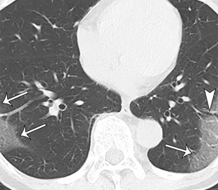 Компьютер научился находить коронавирус в 50 раз быстрее, чем человек