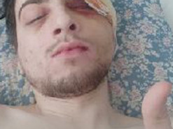 Побитий журналіст Obozrevatel переніс кілька операцій