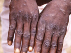 В РФ заявили, що мавпяча віспа була створена в біолабораторії: Держспецзв'язок спростовує черговий фейк окупантів