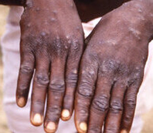 В РФ заявили, що мавпяча віспа була створена в біолабораторії: Держспецзв'язок спростовує черговий фейк окупантів