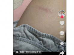 Користувачі iPhone 15 Pro повідомляють про опіки через перегрів