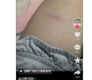 Користувачі iPhone 15 Pro повідомляють про опіки через перегрів