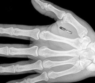 Вместо документов: в Европе людям начали вживлять COVID-чипы под кожу