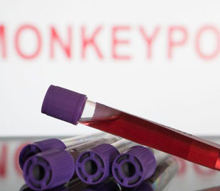 У Європі зафіксували нову смерть від віспи мавп: де саме