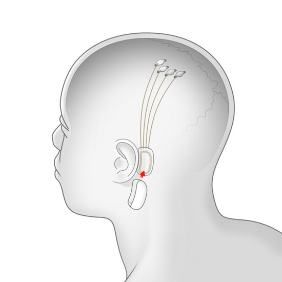 sm.Neuralink-graphic.750.jpg (30 KB)