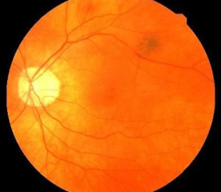 Штучний інтелект навчили виявляти пацієнтів із високим ризиком інфаркту