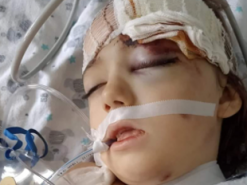 Аферисти видурили майже 130 тис. грн, зібрані на лікування дівчинки, яку збило авто на Буковині
