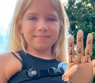 9-річній Саші, яка втратила руку під час обстрілів Бучі, встановили протез