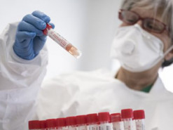 Як відрізнити віспу мавп від "корони": ці поради можуть врятувати життя