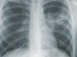 В Аргентині спалах загадкової пневмонії забрав життя 5 людей