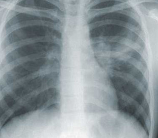 В Аргентині спалах загадкової пневмонії забрав життя 5 людей