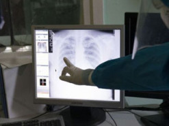 Пневмонія невідомого походження: в Аргентині троє людей померли від незрозумілої інфекції