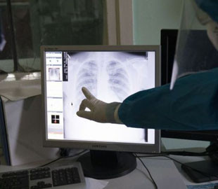 Пневмонія невідомого походження: в Аргентині троє людей померли від незрозумілої інфекції