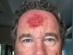 На протестах у Лос-Анджелесі поліцейський поцілив журналісту в голову гумовою кулею