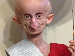 Старішала у 8 разів швидше: померла 19-річна дівчина зірка TikTok з рідкісною вадою