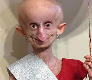 Старішала у 8 разів швидше: померла 19-річна дівчина зірка TikTok з рідкісною вадою