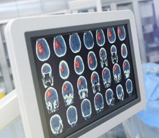 У Європі вперше в мозок людини вживили апарат на основі ШІ